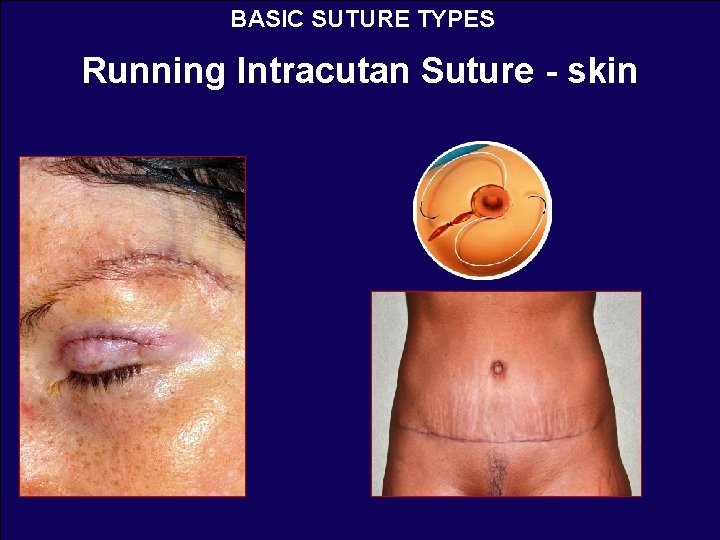 BASIC SUTURE TYPES Running Intracutan Suture - skin 