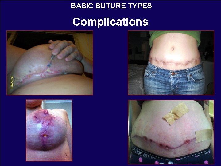 BASIC SUTURE TYPES Complications 