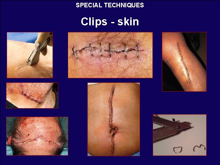 SPECIAL TECHNIQUES Clips - skin 