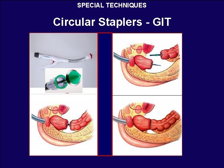 SPECIAL TECHNIQUES Circular Staplers - GIT 