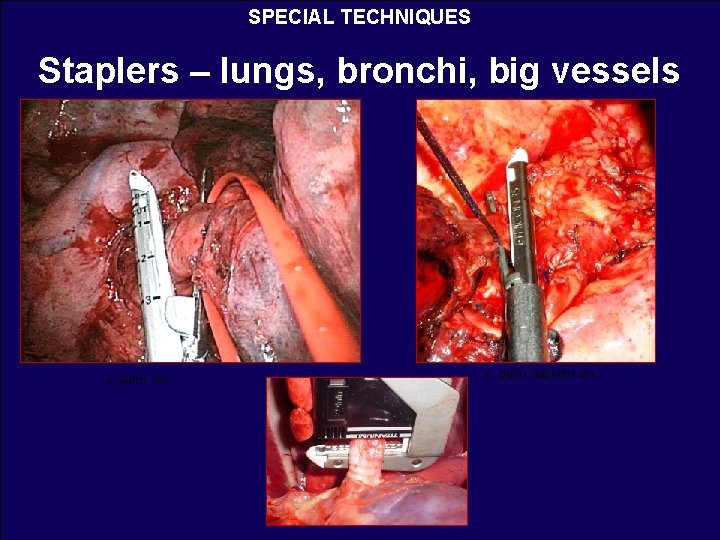 SPECIAL TECHNIQUES Staplers – lungs, bronchi, big vessels a. pulm. sin. v. pulm. superior