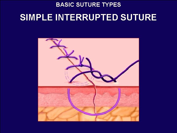 BASIC SUTURE TYPES SIMPLE INTERRUPTED SUTURE 
