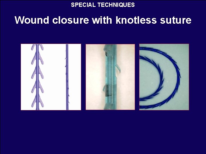 SPECIAL TECHNIQUES Wound closure with knotless suture 