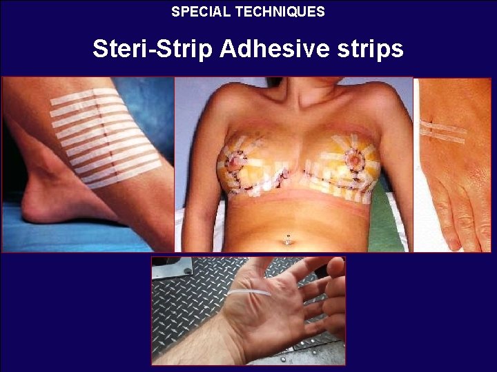 SPECIAL TECHNIQUES Steri-Strip Adhesive strips 