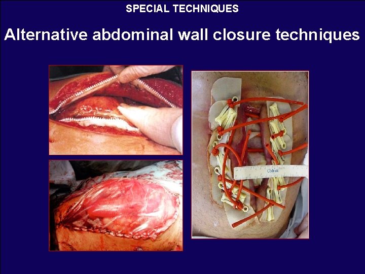 SPECIAL TECHNIQUES Alternative abdominal wall closure techniques 