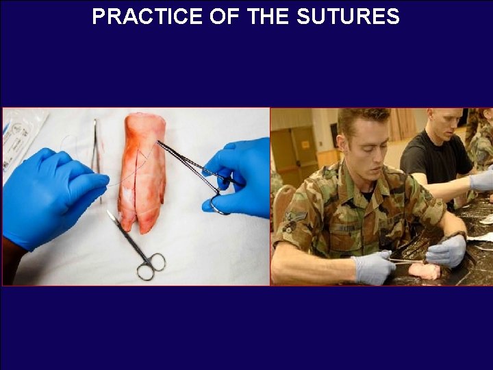 PRACTICE OF THE SUTURES 
