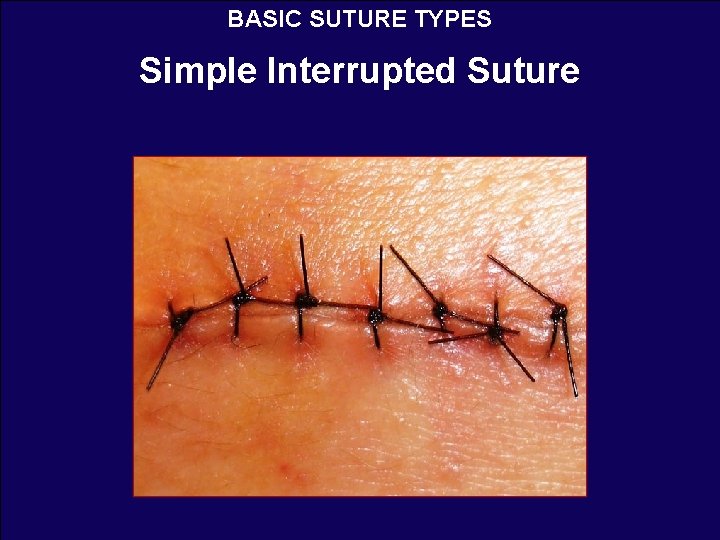 BASIC SUTURE TYPES Simple Interrupted Suture 