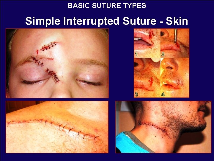 BASIC SUTURE TYPES Simple Interrupted Suture - Skin 