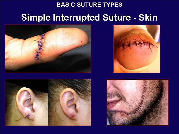 BASIC SUTURE TYPES Simple Interrupted Suture - Skin 
