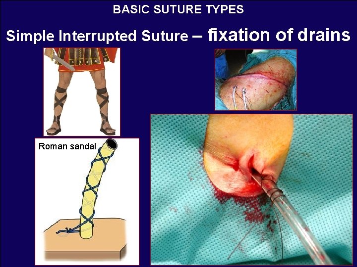 BASIC SUTURE TYPES Simple Interrupted Suture – fixation of drains Roman sandal 
