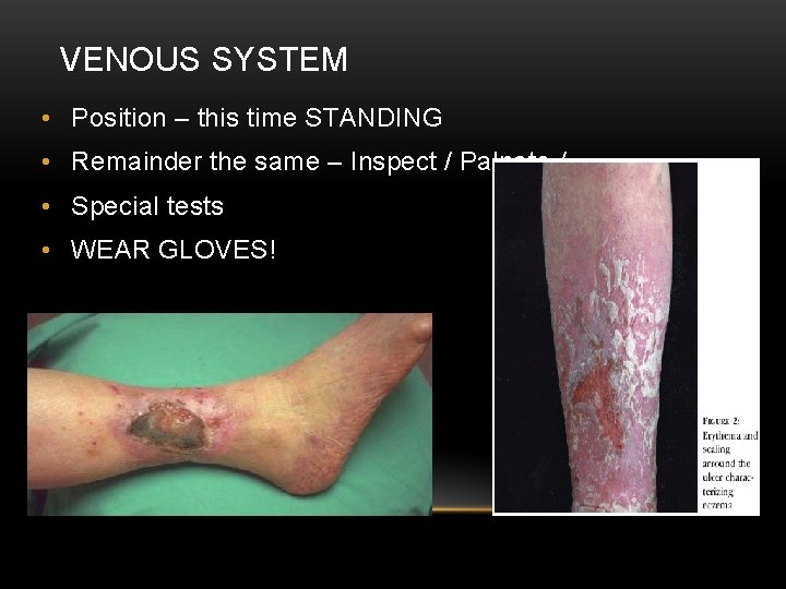VENOUS SYSTEM • Position – this time STANDING • Remainder the same – Inspect