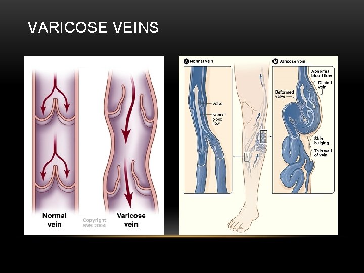 VARICOSE VEINS 