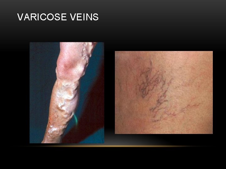 VARICOSE VEINS 