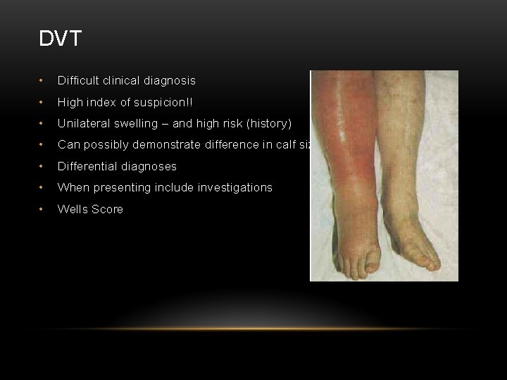 DVT • Difficult clinical diagnosis • High index of suspicion!! • Unilateral swelling –