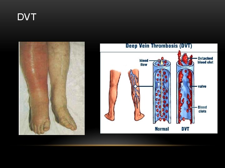 DVT 