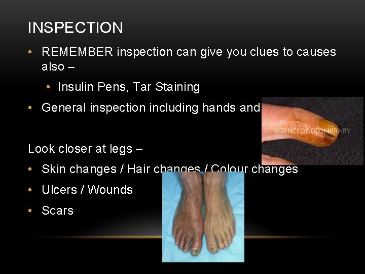 INSPECTION • REMEMBER inspection can give you clues to causes also – • Insulin