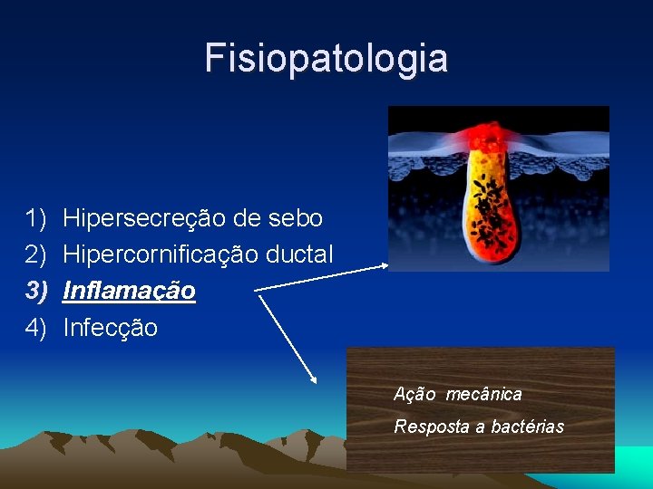 Fisiopatologia 1) 2) 3) 4) Hipersecreção de sebo Hipercornificação ductal Inflamação Infecção Ação mecânica