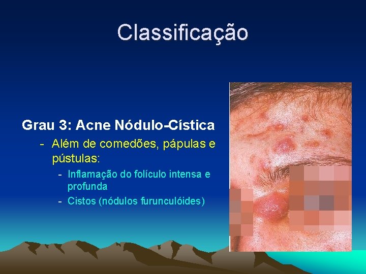 Classificação Grau 3: Acne Nódulo-Cística - Além de comedões, pápulas e pústulas: - Inflamação