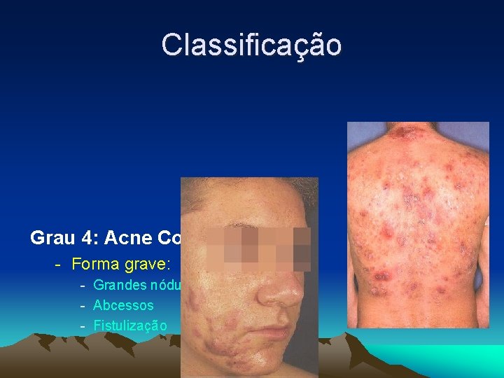 Classificação Grau 4: Acne Conglobata - Forma grave: - Grandes nódulos - Abcessos -