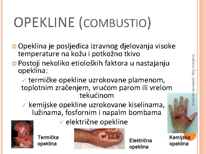 OPEKLINE (COMBUSTIO) Opeklina Termička opeklina Električna opeklina Kemijska opeklina Snežana Žaja, nastavnik-savjetnik je posljedica