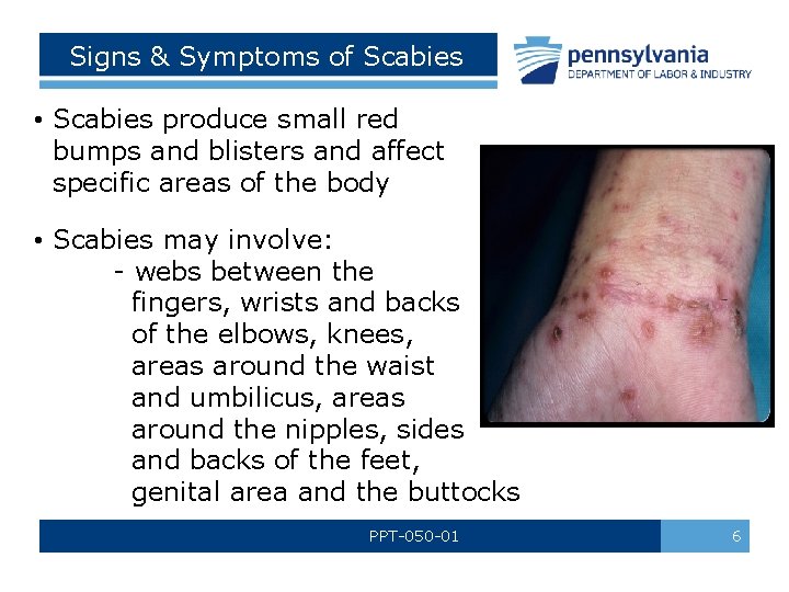 Signs & Symptoms of Scabies • Scabies produce small red bumps and blisters and