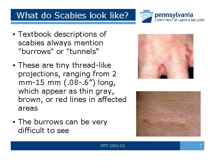 What do Scabies look like? • Textbook descriptions of scabies always mention "burrows" or