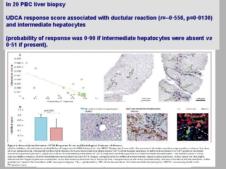 In 20 PBC liver biopsy UDCA response score associated with ductular reaction (r=– 0·