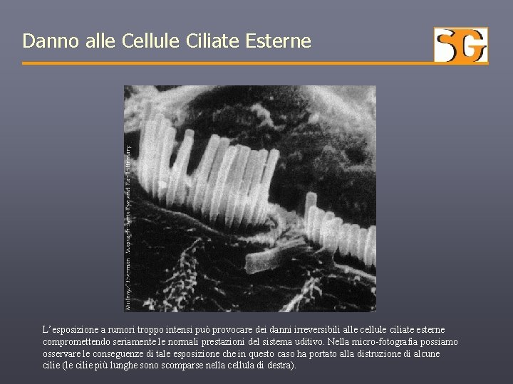 Danno alle Cellule Ciliate Esterne L’esposizione a rumori troppo intensi può provocare dei danni