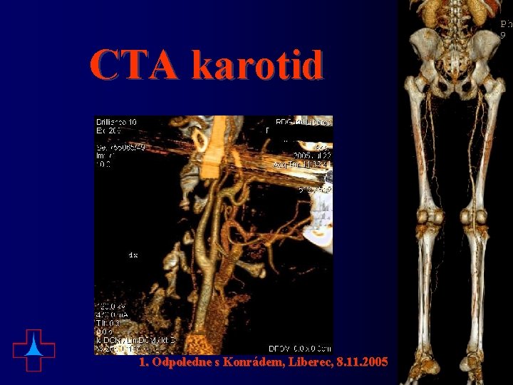 CTA karotid 1. Odpoledne s Konrádem, Liberec, 8. 11. 2005 