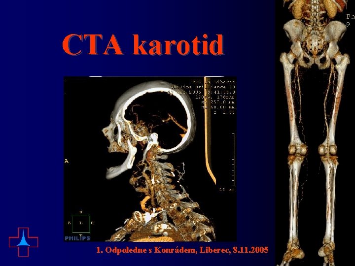 CTA karotid 1. Odpoledne s Konrádem, Liberec, 8. 11. 2005 