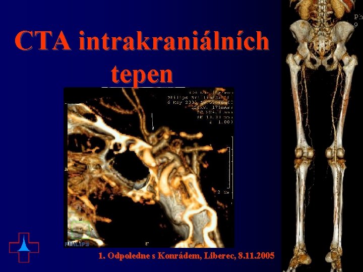 CTA intrakraniálních tepen 1. Odpoledne s Konrádem, Liberec, 8. 11. 2005 