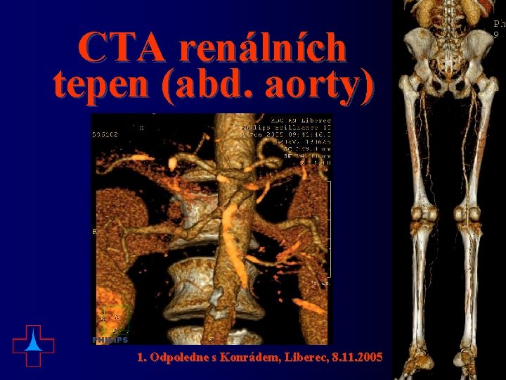 CTA renálních tepen (abd. aorty) 1. Odpoledne s Konrádem, Liberec, 8. 11. 2005 