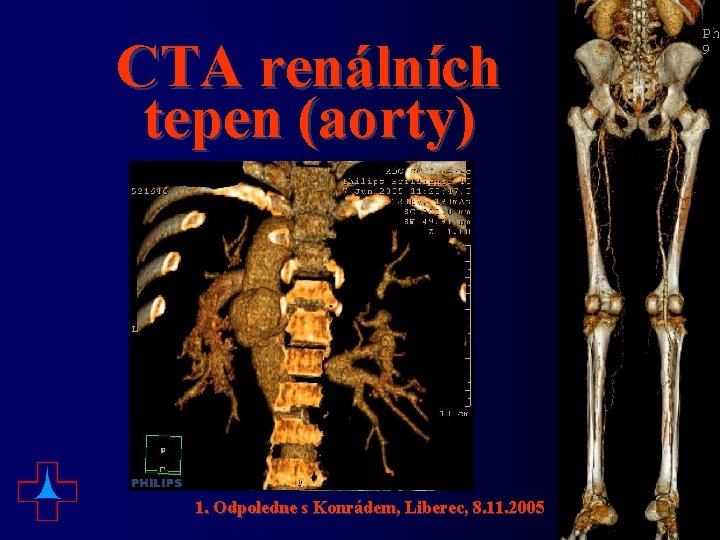 CTA renálních tepen (aorty) 1. Odpoledne s Konrádem, Liberec, 8. 11. 2005 