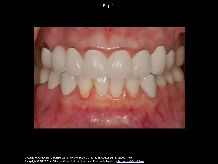 Fig. 1 Journal of Prosthetic Dentistry 2012 107349 -352 DOI: (10. 1016/S 0022 -3913(12)00071