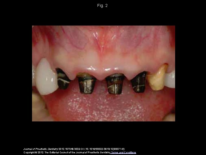 Fig. 2 Journal of Prosthetic Dentistry 2012 107349 -352 DOI: (10. 1016/S 0022 -3913(12)00071
