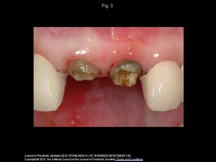Fig. 3 Journal of Prosthetic Dentistry 2012 107349 -352 DOI: (10. 1016/S 0022 -3913(12)00071