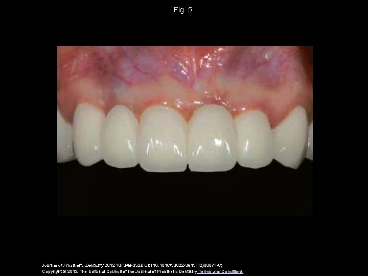 Fig. 5 Journal of Prosthetic Dentistry 2012 107349 -352 DOI: (10. 1016/S 0022 -3913(12)00071