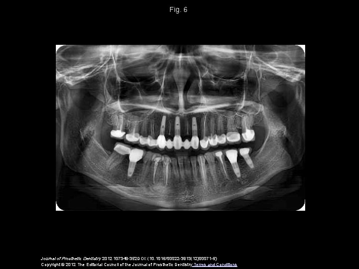 Fig. 6 Journal of Prosthetic Dentistry 2012 107349 -352 DOI: (10. 1016/S 0022 -3913(12)00071