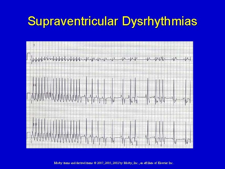 Supraventricular Dysrhythmias Mosby items and derived items © 2007, 2005, 2002 by Mosby, Inc.
