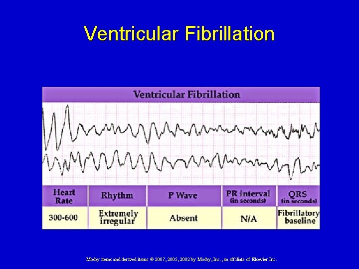 Ventricular Fibrillation Mosby items and derived items © 2007, 2005, 2002 by Mosby, Inc.