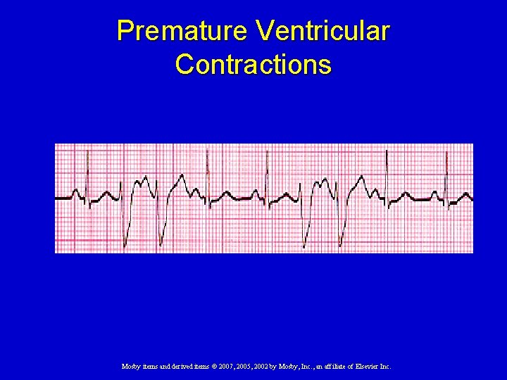 Premature Ventricular Contractions Mosby items and derived items © 2007, 2005, 2002 by Mosby,
