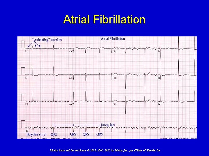 Atrial Fibrillation Mosby items and derived items © 2007, 2005, 2002 by Mosby, Inc.