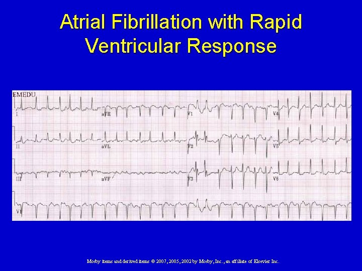 Atrial Fibrillation with Rapid Ventricular Response Mosby items and derived items © 2007, 2005,