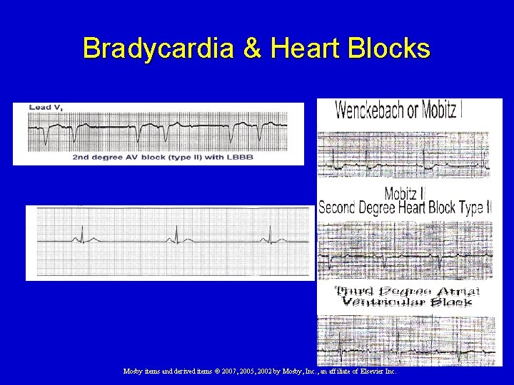 Bradycardia & Heart Blocks Mosby items and derived items © 2007, 2005, 2002 by