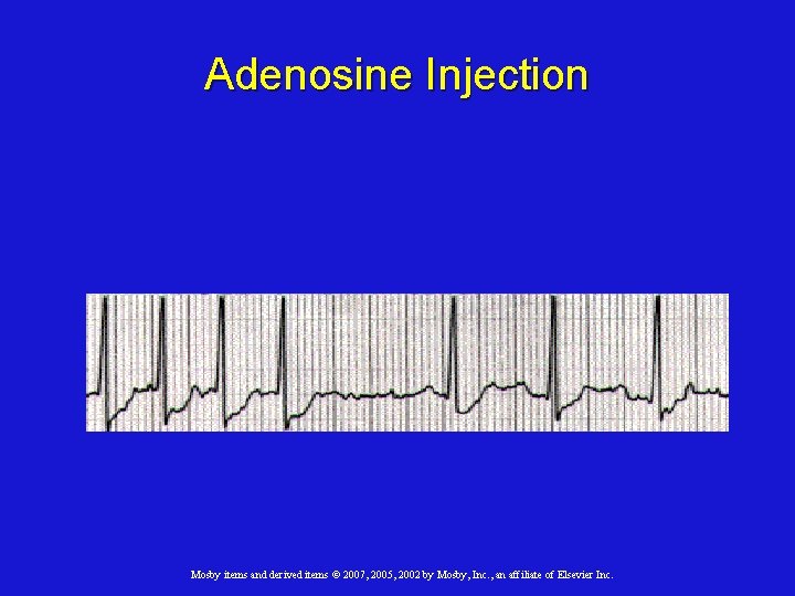 Adenosine Injection Mosby items and derived items © 2007, 2005, 2002 by Mosby, Inc.