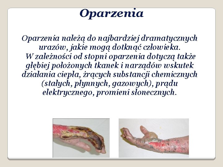 Oparzenia należą do najbardziej dramatycznych urazów, jakie mogą dotknąć człowieka. W zależności od stopni