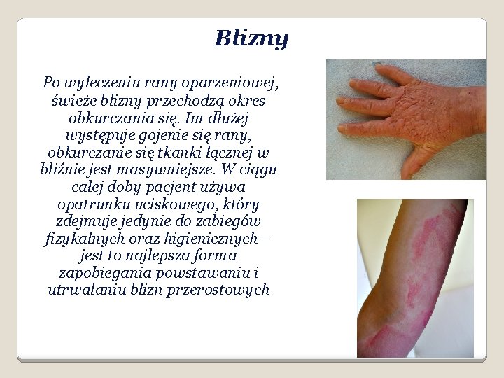 Blizny Po wyleczeniu rany oparzeniowej, świeże blizny przechodzą okres obkurczania się. Im dłużej występuje
