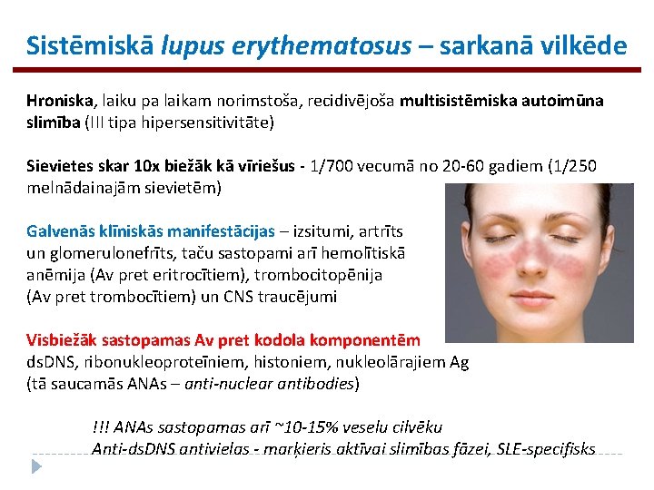 Sistēmiskā lupus erythematosus – sarkanā vilkēde Hroniska, laiku pa laikam norimstoša, recidivējoša multisistēmiska autoimūna