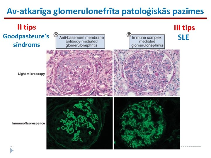 Av-atkarīga glomerulonefrīta patoloģiskās pazīmes II tips Goodpasteure’s sindroms III tips SLE 