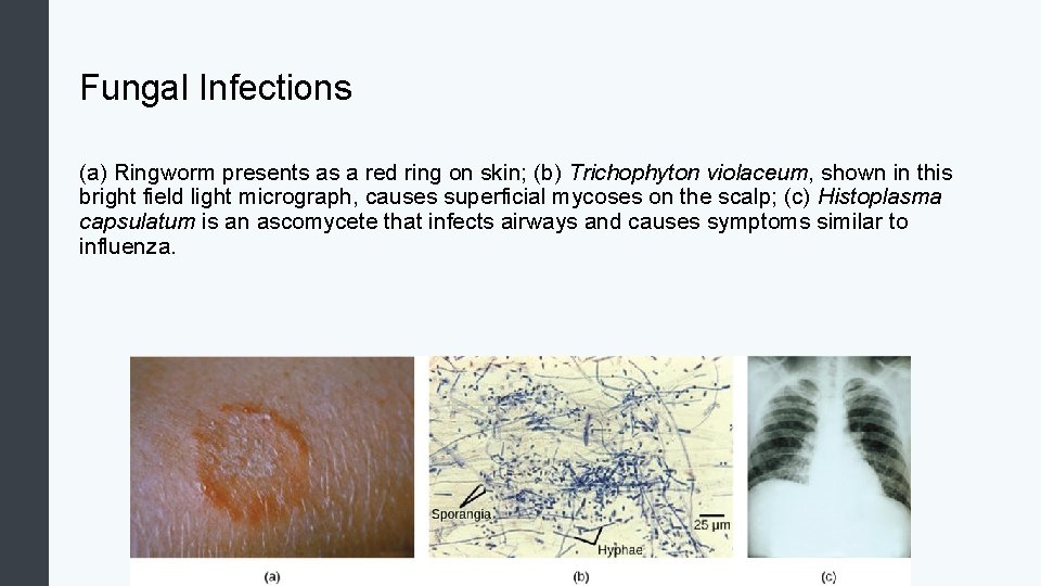 Fungal Infections (a) Ringworm presents as a red ring on skin; (b) Trichophyton violaceum,